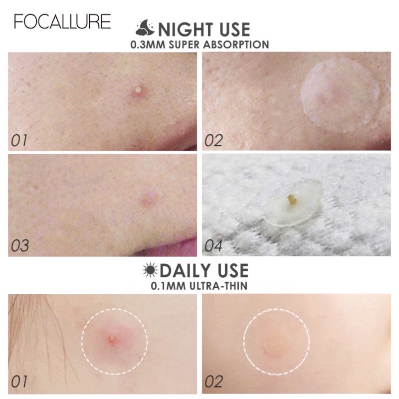 FOCALLURE - ACNE PIMPLE PATCH | OBAT PENGHILANG JERAWAT AMAN AMPUH VIRAL ORIGINAL