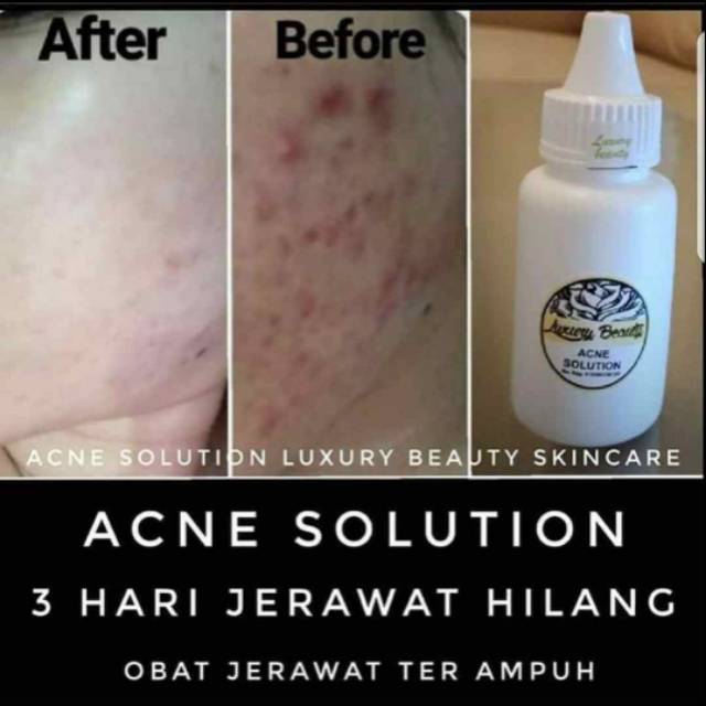 Acne solutions