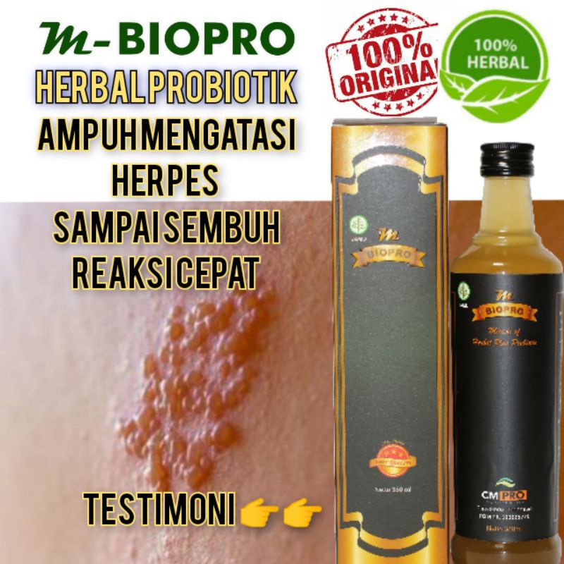 Obat Herpes l Obat Herpes Kulit l Obat Herpes Kelamin