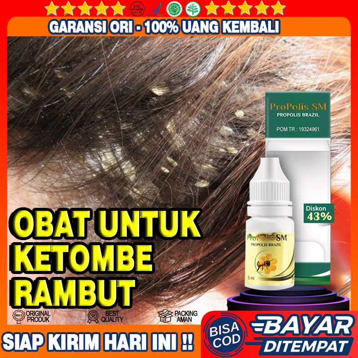 Obat Ketombe Rambut, Ketombe Di Rambut, Ketombe Di Rambut Gatal - Propolis SM Asli