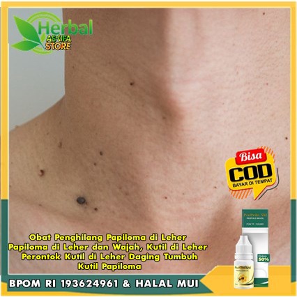 Obat Penghilang Papiloma di Leher, Papiloma di Leher dan Wajah, Kutil di Leher, Perontok Kutil di Le