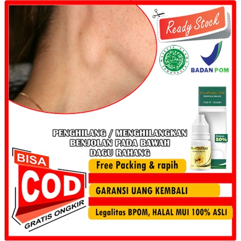 PROPOLIS SM ORIGINAL PENGHILANG / MENGHILANGKAN  BENJOLAN PADA BAWAH DAGU RAHANG, BELAKANG TELINGA L