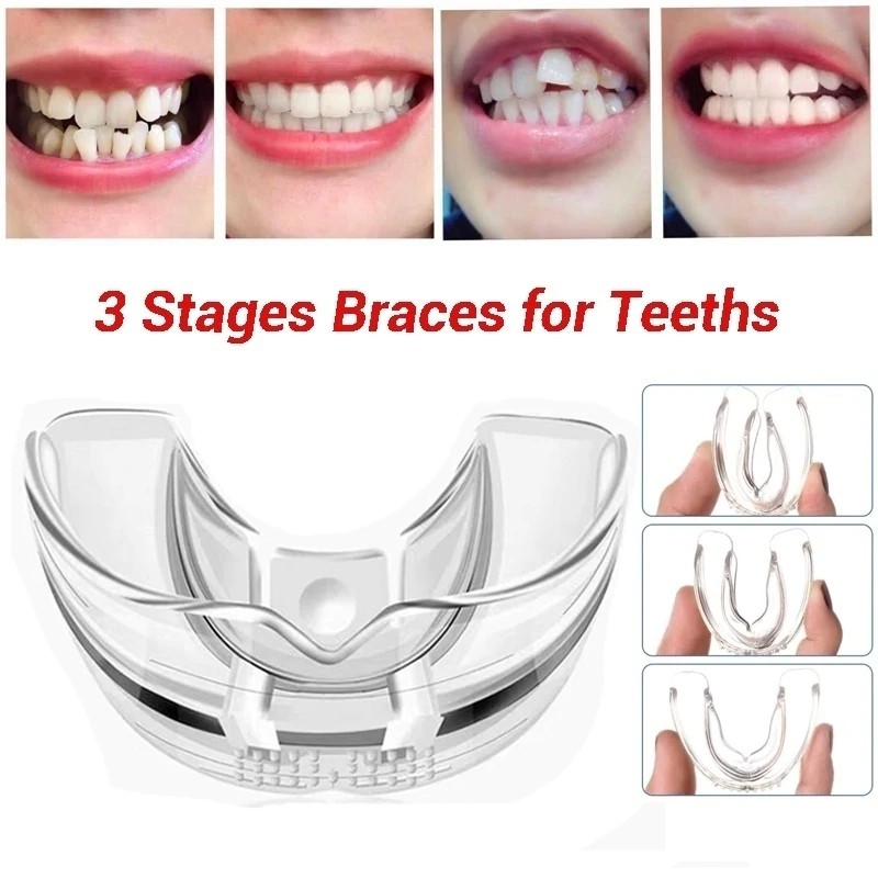 [Putih] Perapi Gigi Tanpa Behel dari Bahan Silikon Orthodentic Retainer Teeth Ampuh dalam 3 Bulan