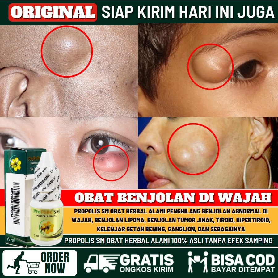 Salep Penghilang Benjolan Lipoma di Wajah, Obat Oles Benjolan Abnormal di Wajah, Salep Benjolan Kera