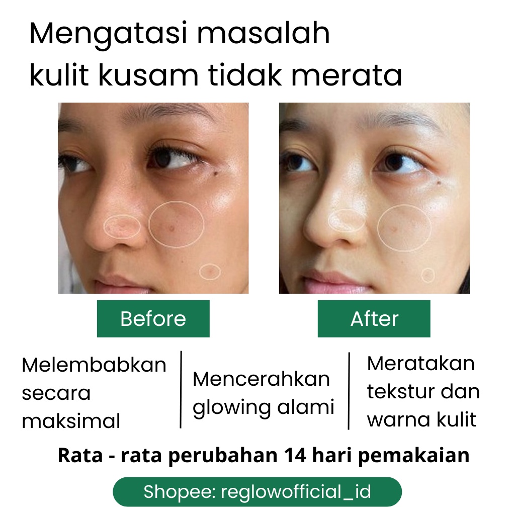 REGLOW FLEK Skincare dr Shindy Putri 1 Paket Lengkap Murah Untuk Acne Ibu Hamil Remaja Kulit Berminyak Berjerawat Dan Bruntusan Penghilang Komedo Milia Official Original Store Resmi