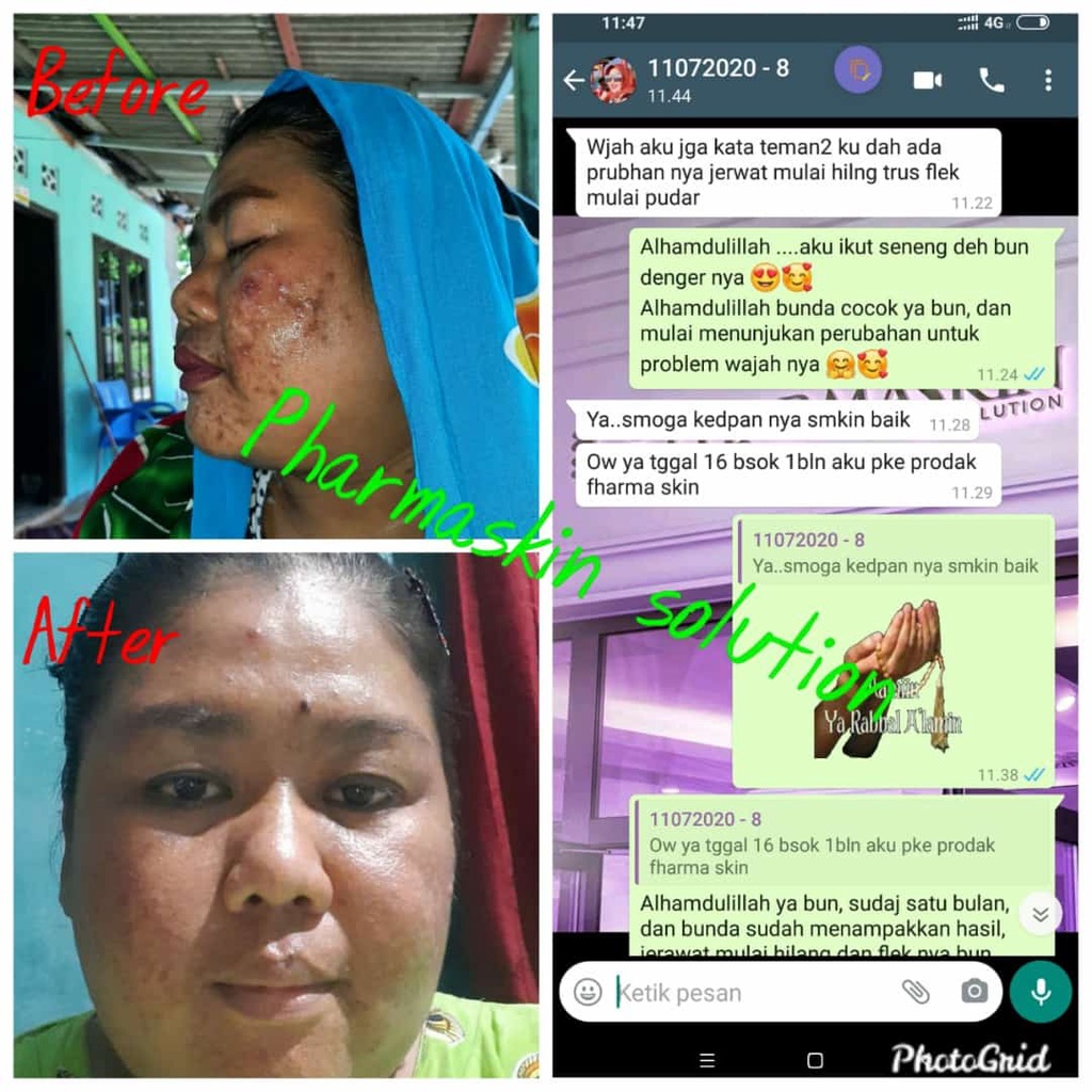 Pharmaskin Paket Full Treatment Acne Glowing Series Bebas Menghilangkan Jerawat Perawatan Wajah Berjerawat Glowing Ampuh Resmi BPOM Halal Original-2