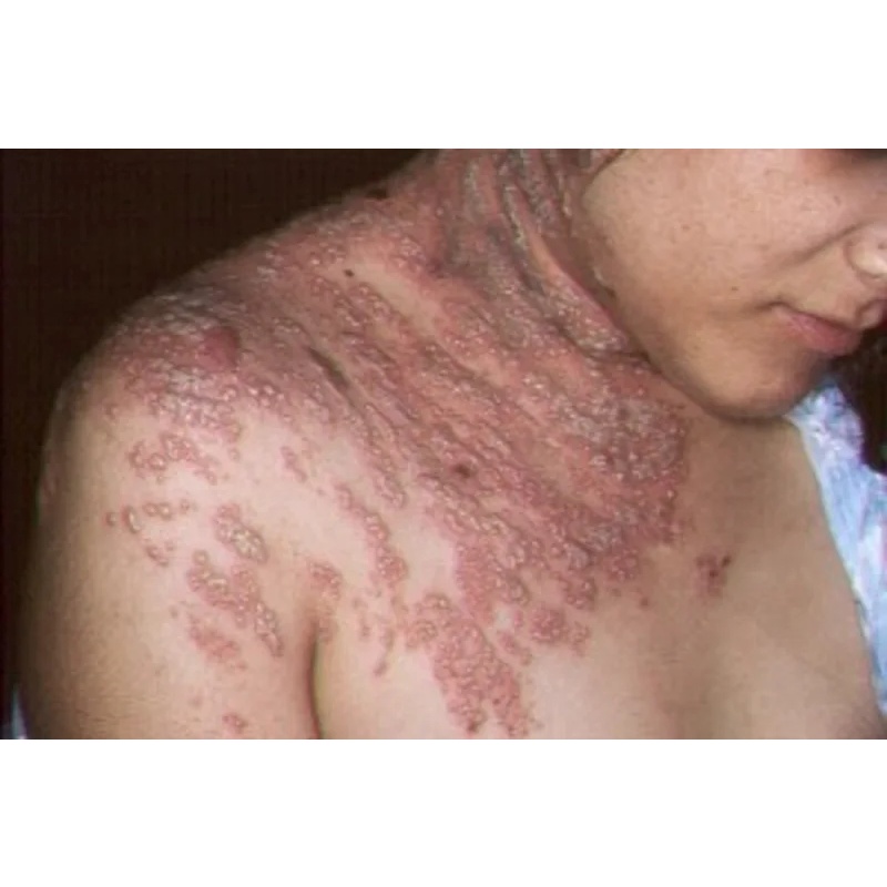 Salep GTL Original 100% Asli Gatel Usir Kudis Kurap Panu Korengan-7