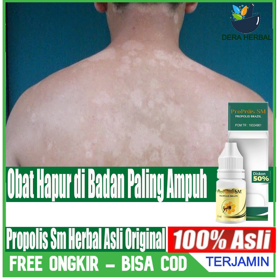 Obat Herbal untuk hapur di badan obat hapur di wajah Propolis Sm Herbal Original Gold