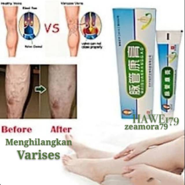 MAIGUAN KANGGAO KRIM PENGHILANG VARISES - SALEP VARISES