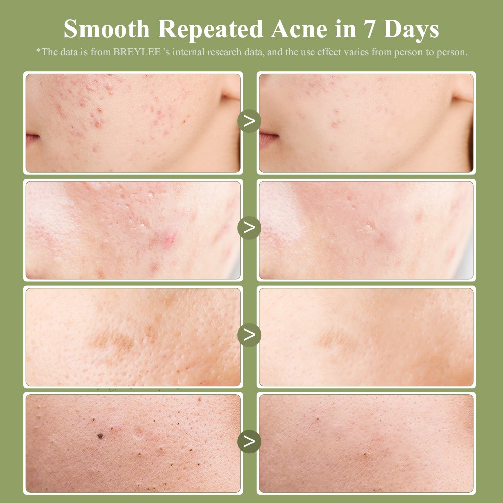 [BPOM] BREYLEE Tea Tree Salicylic Acid Cleaning Pads Pad