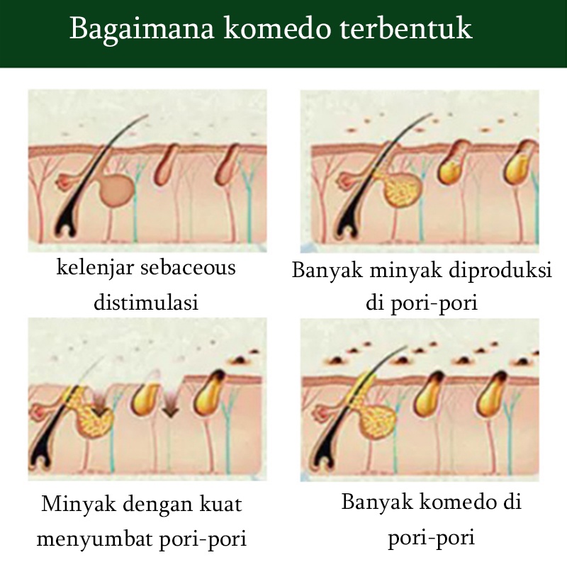 Masker penghilang komedo Pembersih komedoPENGHILANG KOMEDO MEMBANDEL,KULIT KASAR,FLEK HITAM,BEKAS JERAWAT,Pori2 besar MENCERAHKAN KULIT