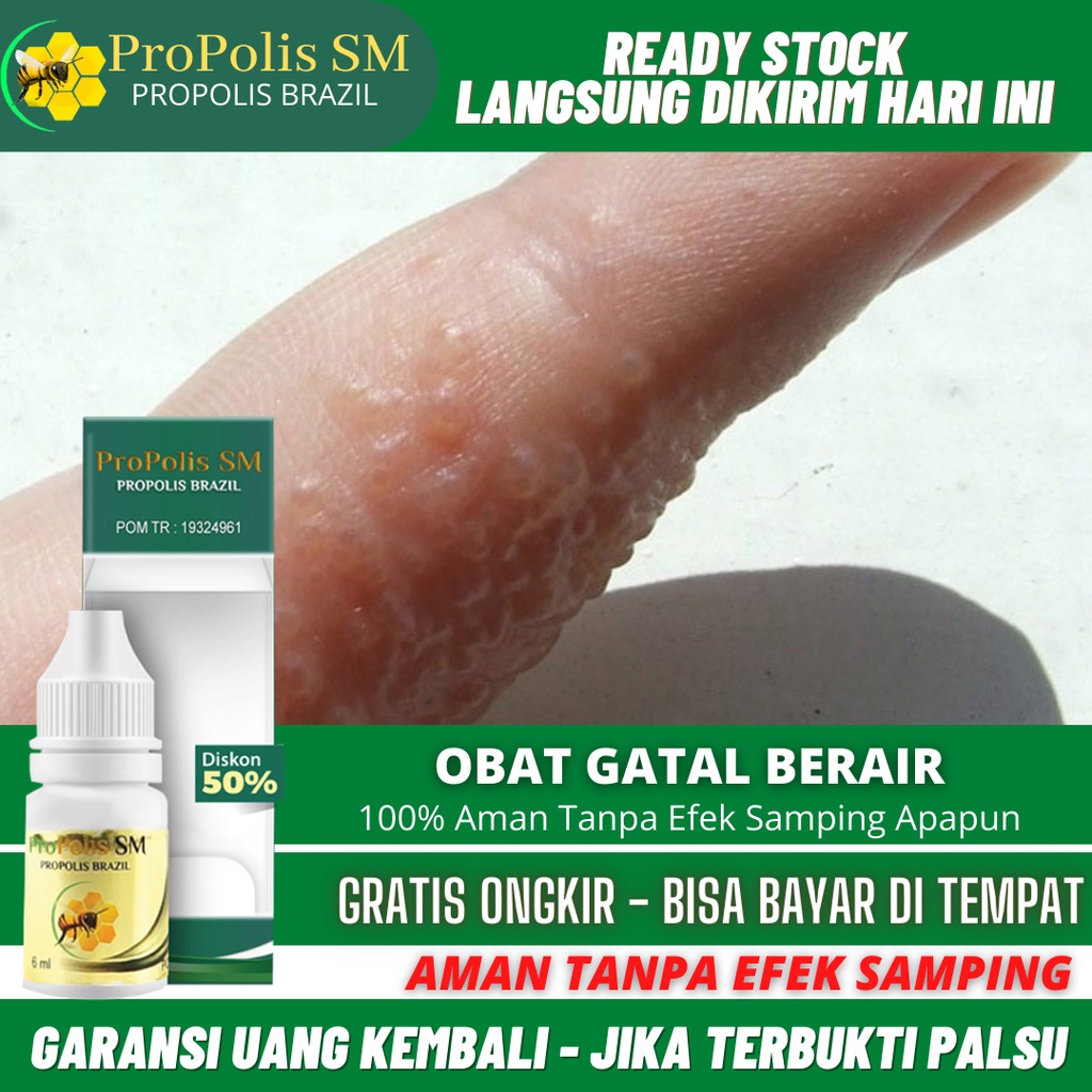Obat Gatal Berair Dan Bernanah, Gatal Bintik Berair, Gatal Berair di Jari Tangan dan Kaki, Bintik Me