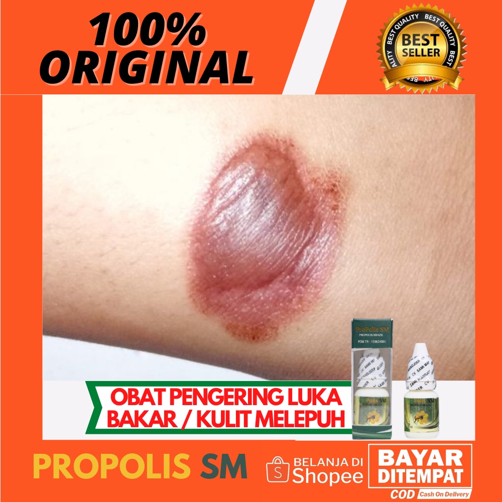 Obat Pengering Luka Knalpot / Luka Bakar Melepuh Berair / Luka Bakar Memutih / Obat Untuk Perawatan 