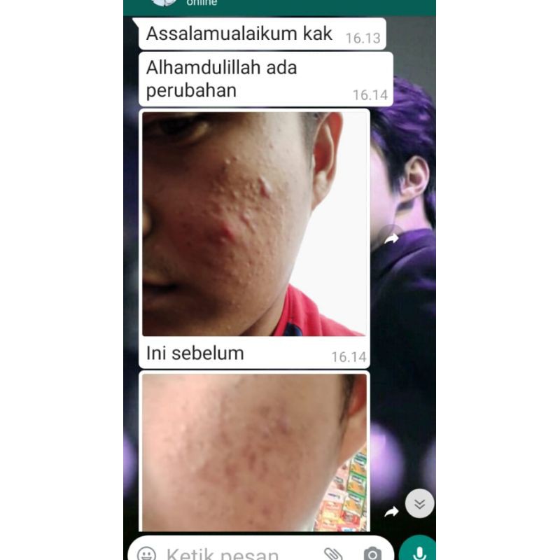 Clorismen Acne Series Paket Skincare Pria Anti Jerawat &amp; Bekas Jerawat