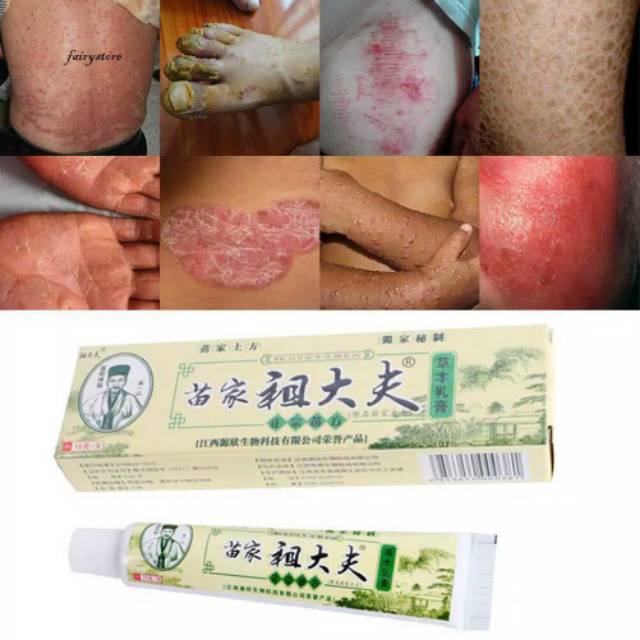 Obat Anti Bakteri Penyakit Kulit Gatal Dermatitis Eczema Anti Fungus Shopee Indonesia