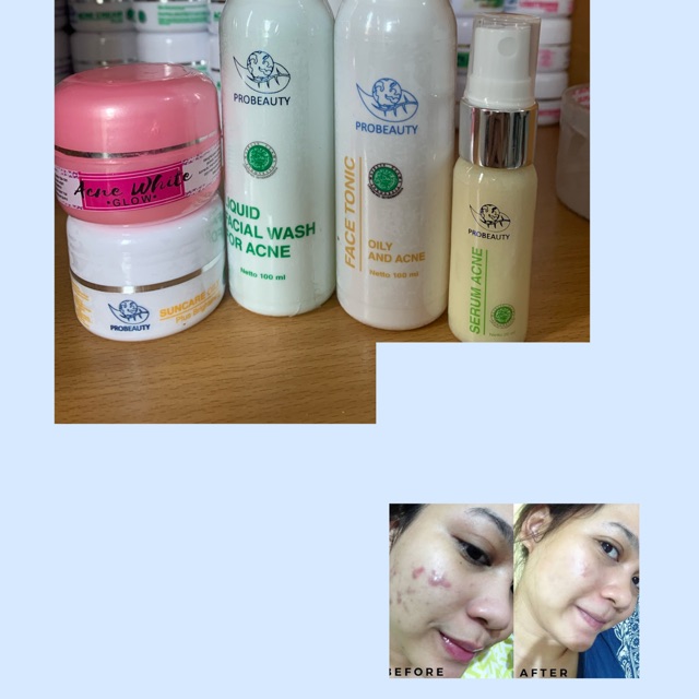 [ COD PROBEAUTY ACNE WHITE FORTE / PROBAEUTY ACNE GLOW FORTE
