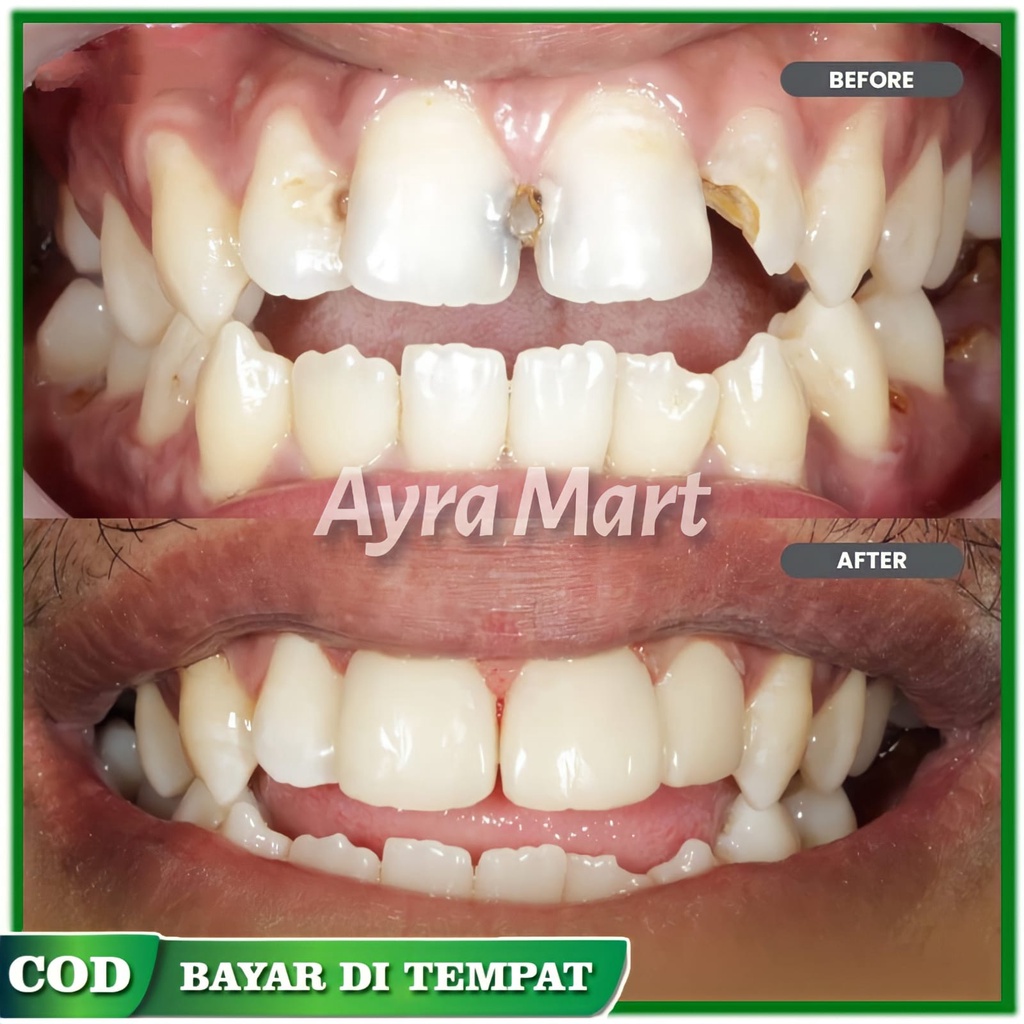 KUAT PERMANEN  Tambal gigi ompong depan Penambal gigi berlubang permanen ori Tambal gigi bolong dan keropos Gigi palsu instan atas bawah original Penutup gigi berlubang permanen Penutup gigi ompong Temptooth Temporary Tooth Asli 100% Original Aman