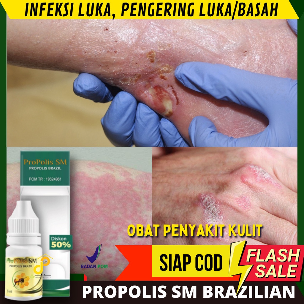 PROPOLIS SM OBAT OLES INFEKSI LUKA, PENGERING LUKA/BASAH - bekas luka koreng, luka gatal atau alergi