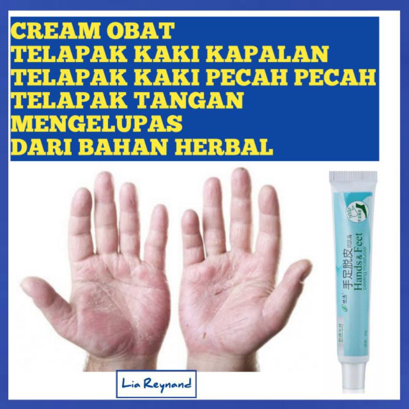 Cream Obat Telapak Kaki Kapalan Telapak Kaki Pecah Pecah Telapak Tangan Mengelupas Shopee Indonesia