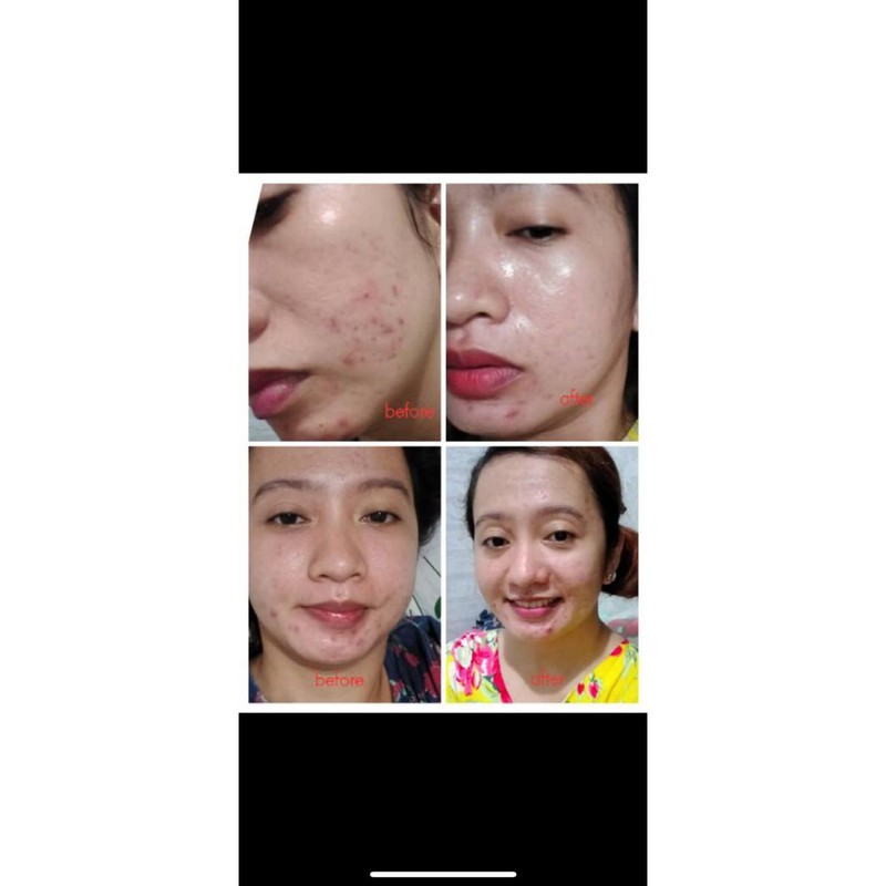 CREAM ACNE CLEAR KRIM JERAWAT AMPUH BPOM BRUNTUSAN KRIM DOKTER HALAL PRIA WANITA AMAN BUMIL BUSUI