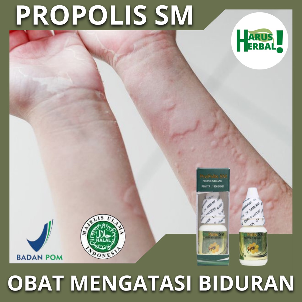 Obat Biduran Alami, Obat Mengatasi Biduran, Obat Biduran Kronis, Obat Gatal Biduran, Obat Gatal Aler