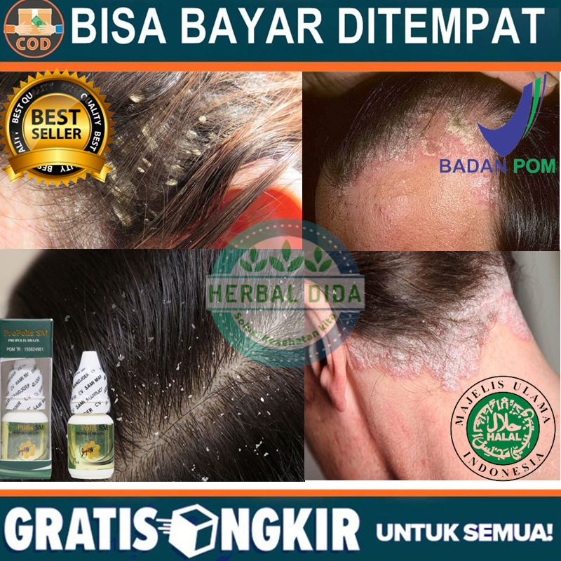Obat Tetes Ketombe Parah, Obat Kulit Kepala Berkerak, Obat Ketombe Berkerak Rambut, Obat Penghilang 