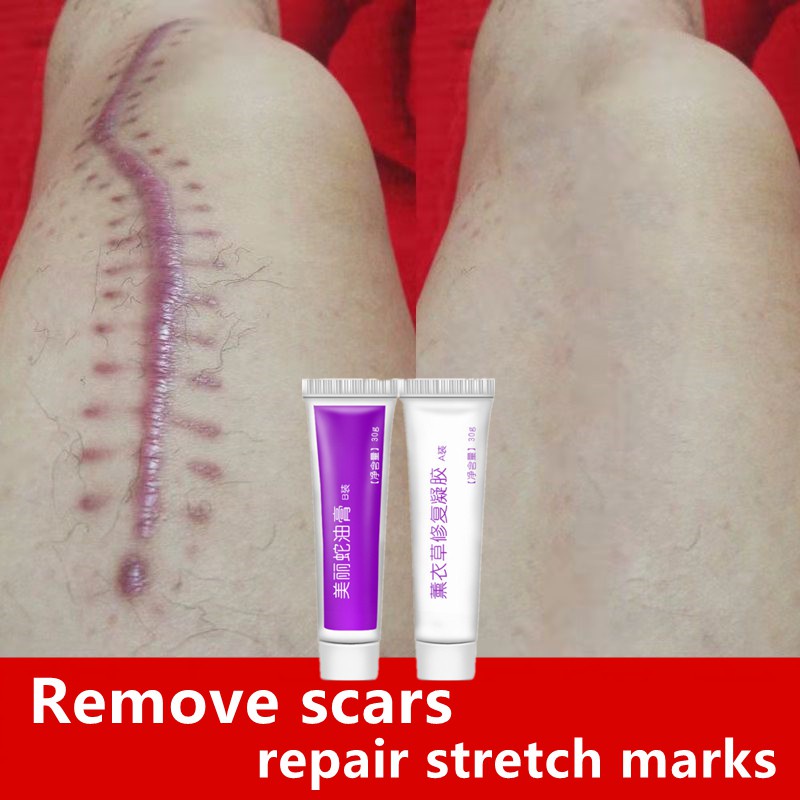 Jual Penghilang bekas luka Acne Cream Scar Removal Penghilang Noda