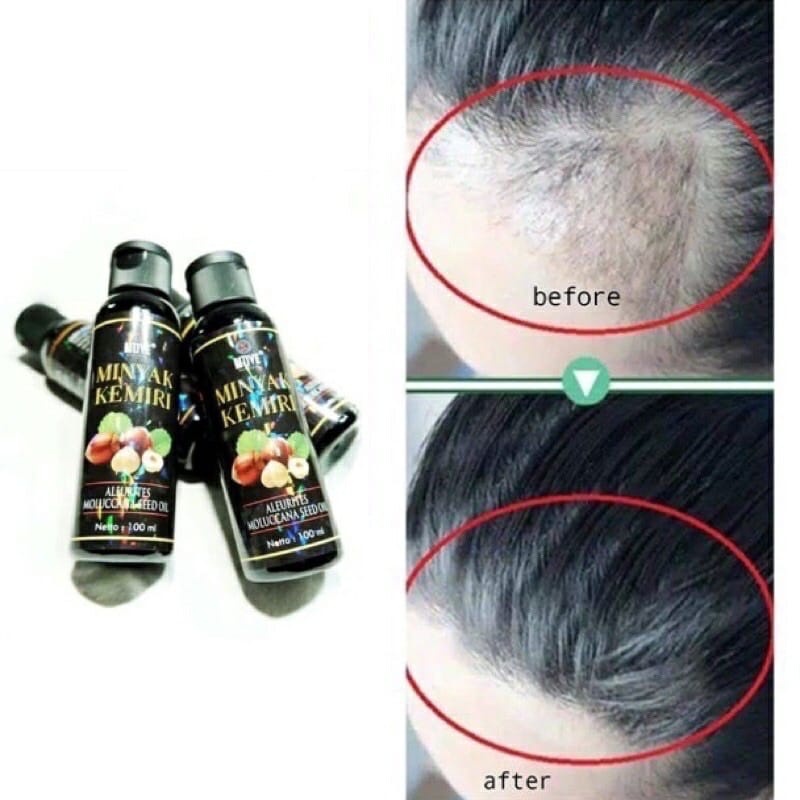 (SATUAN)MINYAK KEMIRI NOVE 100ML/MINYAK KEMIRI PENUMBUH RAMBUT BPOM ORIGINAL/SHAMPOO KEMIRI PENEBAL RAMBUT