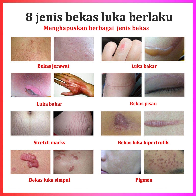 【Barang spot】cream penghilang bekas luka jerawat hitam koreng menghilangkan bekas jerawat sabun penghilang bekas luka serum penghilang bekas jerawat dermatik penghilang bekas luka salep bekas luka obat menghilangkan bekas luka