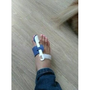 ♬ hallux valgus. splint , bunion pad, pemisah jari, night splint ➺