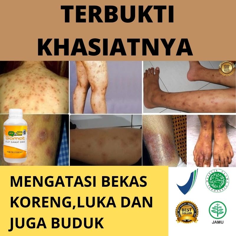 Jual Obat Penyakit Kulit,Scabies,Herpes,Eksim,Buduk,Kudis-Perontok ...