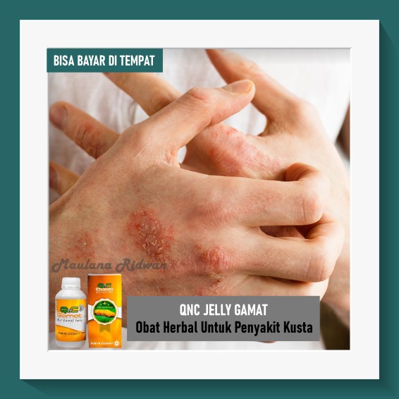 Obat Kusta, Kusta Kering / Basah, Lepra, Obat Oles Penyakit Kusta - QnC Jelly Gamat