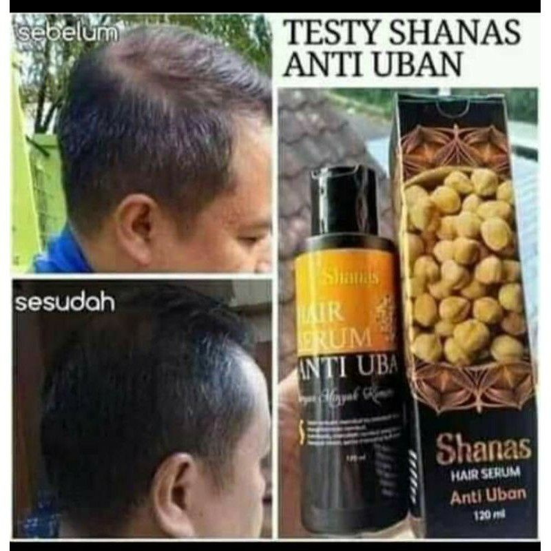 Serum uban shanas/serum uban nasa/serum uban permanen/serum penghilang uban/serum antiuban permanen