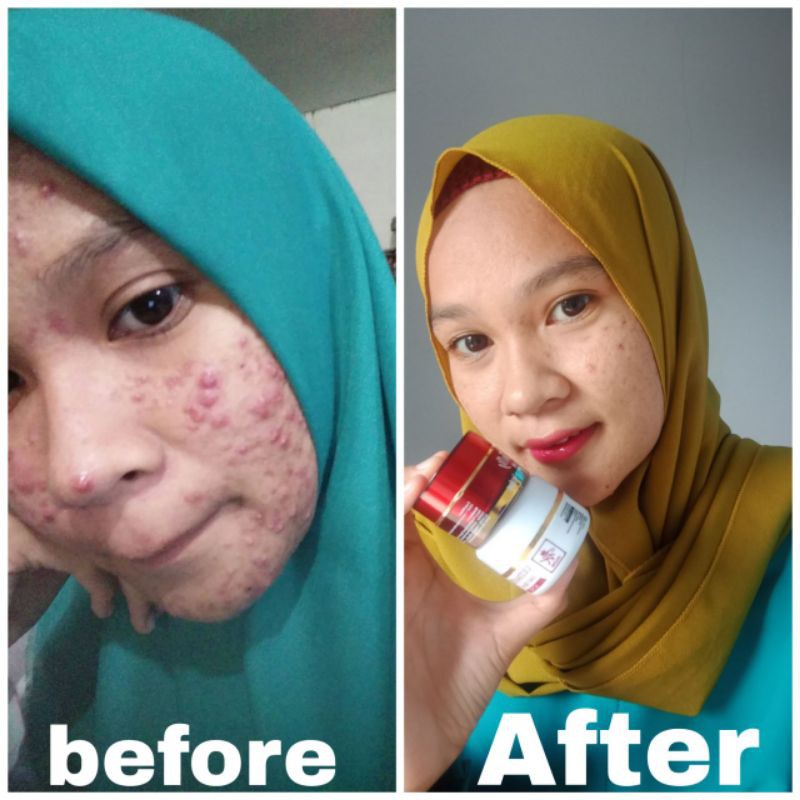 COD - RK GLOW ACNE - PAKET SKINCARE JERAWAT - MENGHILANGKAN ACNE DAN BEKASNYA - MEMBUAT MULUS