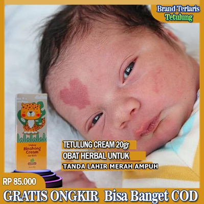 Obat Penghilang Tanda Lahir Cokelat, Hitam, Merah Di Wajah Anak Dan Dewasa Tanpa Efek Samping Cream 
