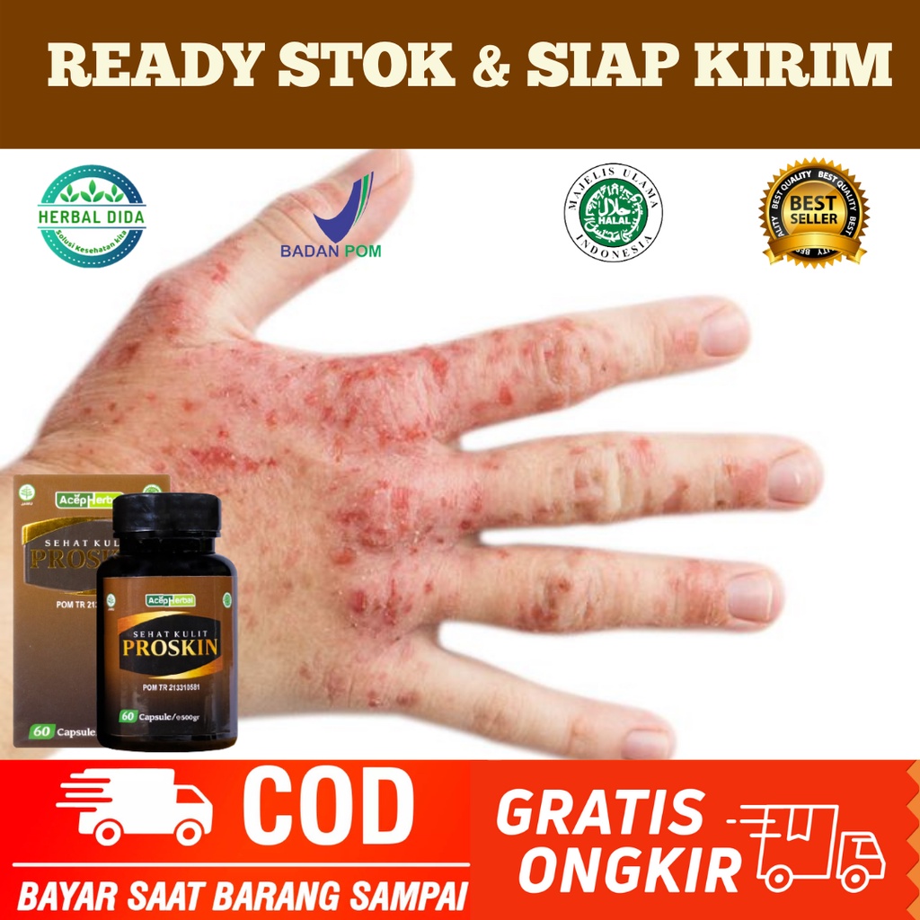 Obat Herbal Kulit Gatal, Obat Ruam Kulit, Obat Kulit Gatal Jerawat Ruam, Obat Ruam Merah, Penghilang