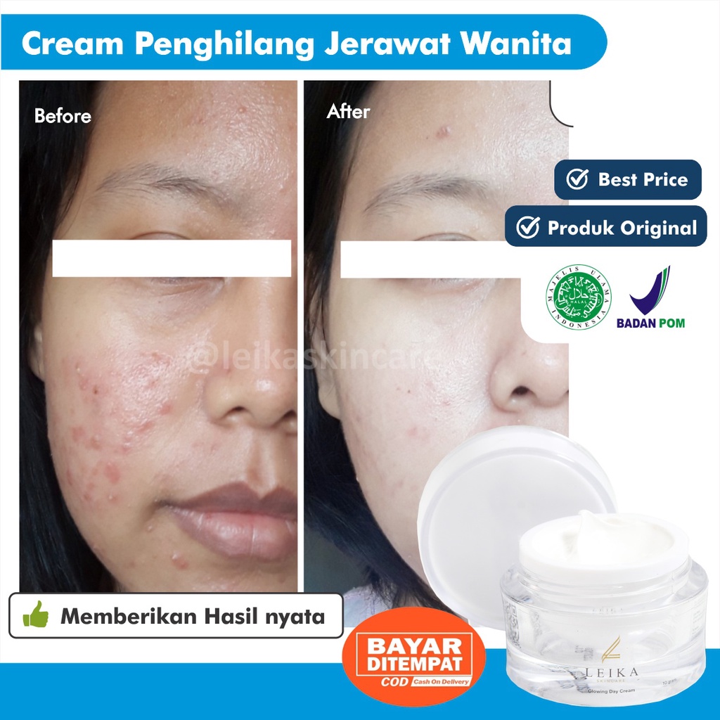 Cream Acne BPOM Cream Penghilang Jerawat dan Bekas Jerawat Ampuh Obat Jerawat Acnes Creamy Wash Ori 