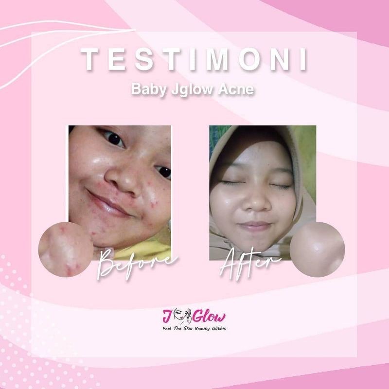 SKINCARE BABY JGLOW UNTUK KULIT BERMINYAK/JERAWAT