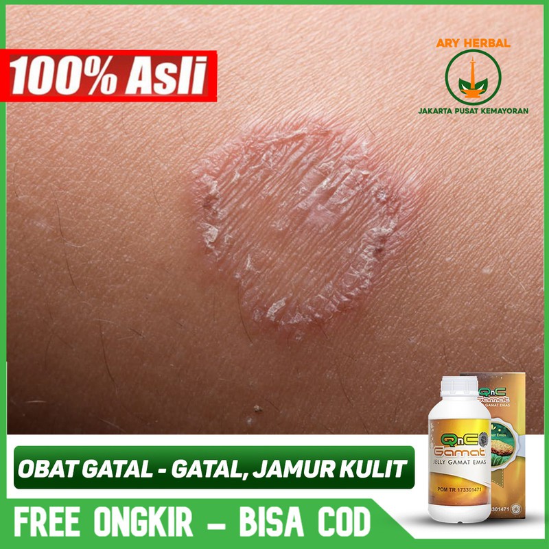 

Obat Gatal - Gatal, Jamur Kulit, Alergi Dingin, Kurap, Panu Herbal QnC Jelly Gamat Terlaris Bisa COD