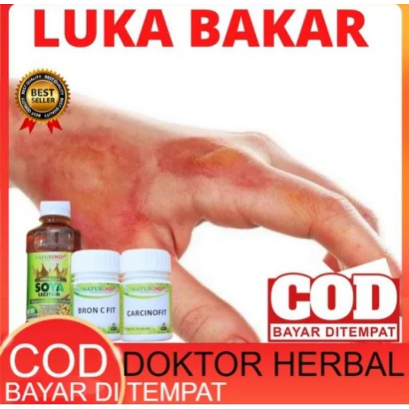 OBAT LUKA BAKAR KULIT MELEPUH KULIT TERBAKAR PALING AMPUH