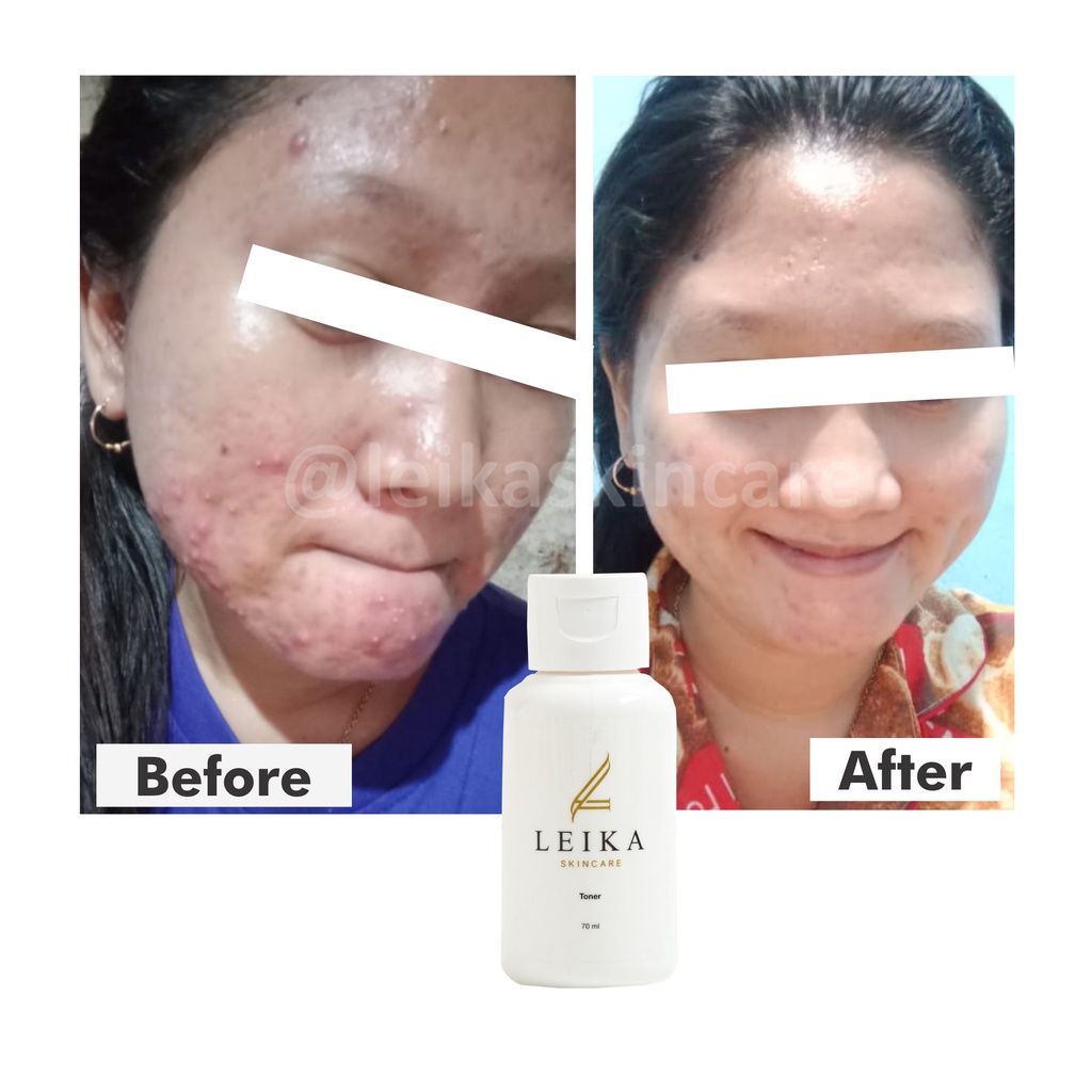 Toner Wajah Mengurangi Wajah Berminyak Toner Wajah Berminyak &amp; Berjerawat Bruntusan BPOM Asli 100% Toner Leika Skincare Halal MUI Original