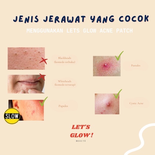 HYDROCOLLOID ACNE PIMPLE PATCH TRANSPARAN LETSGLOWBEAUTE