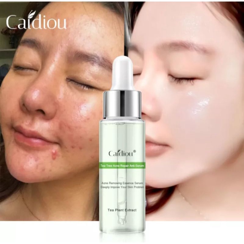 CAIDIOU SERUM TREATMENT JERAWAT | MENGHILANGKAN JERAWAT & BEKASNYA - KONTROL MINYAK WAJAH - MELEMBAB