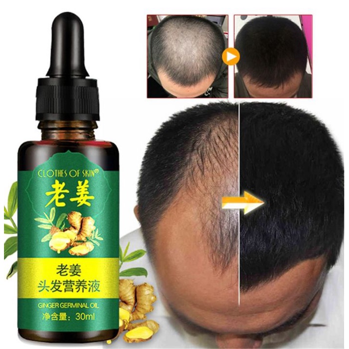 Obat Penumbuh Rambut Rontok Herbal Essence Mengatasi Kerontokan Rambut Botak