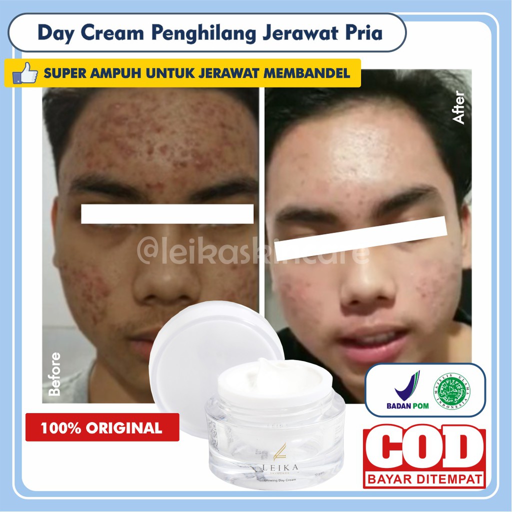 [KRIM SIANG JERAWAT PRIA] Penghilang Jerawat Pria Krim Jerawat Ampuh Penghilang Jerawat Dan Bekas Je