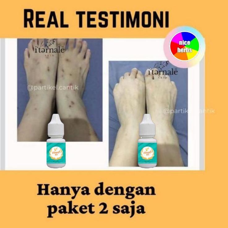 74 ☊➯ VITASOFTOIL ORIGINAL VITA OIL VITASOFT OIL PENGHILANG KELOID BEKAS LUKA BOPENG STRECHMARK ☊ (G