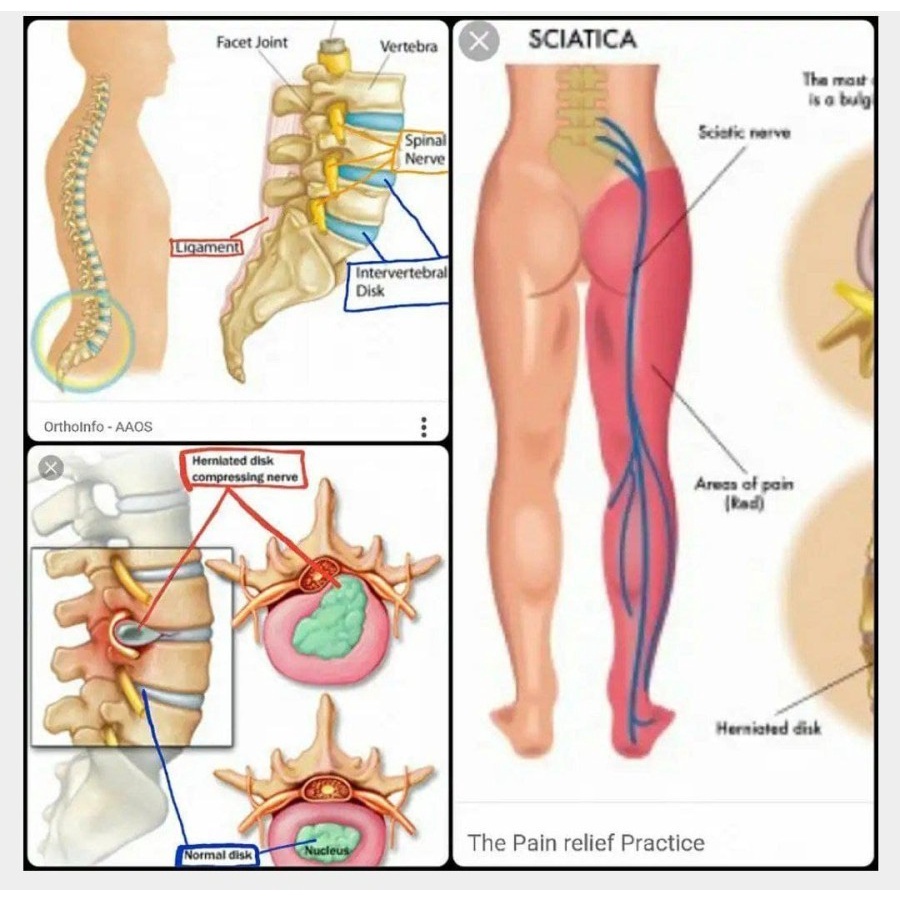 Nheo Z therapy nheoz terapi sakit punggung