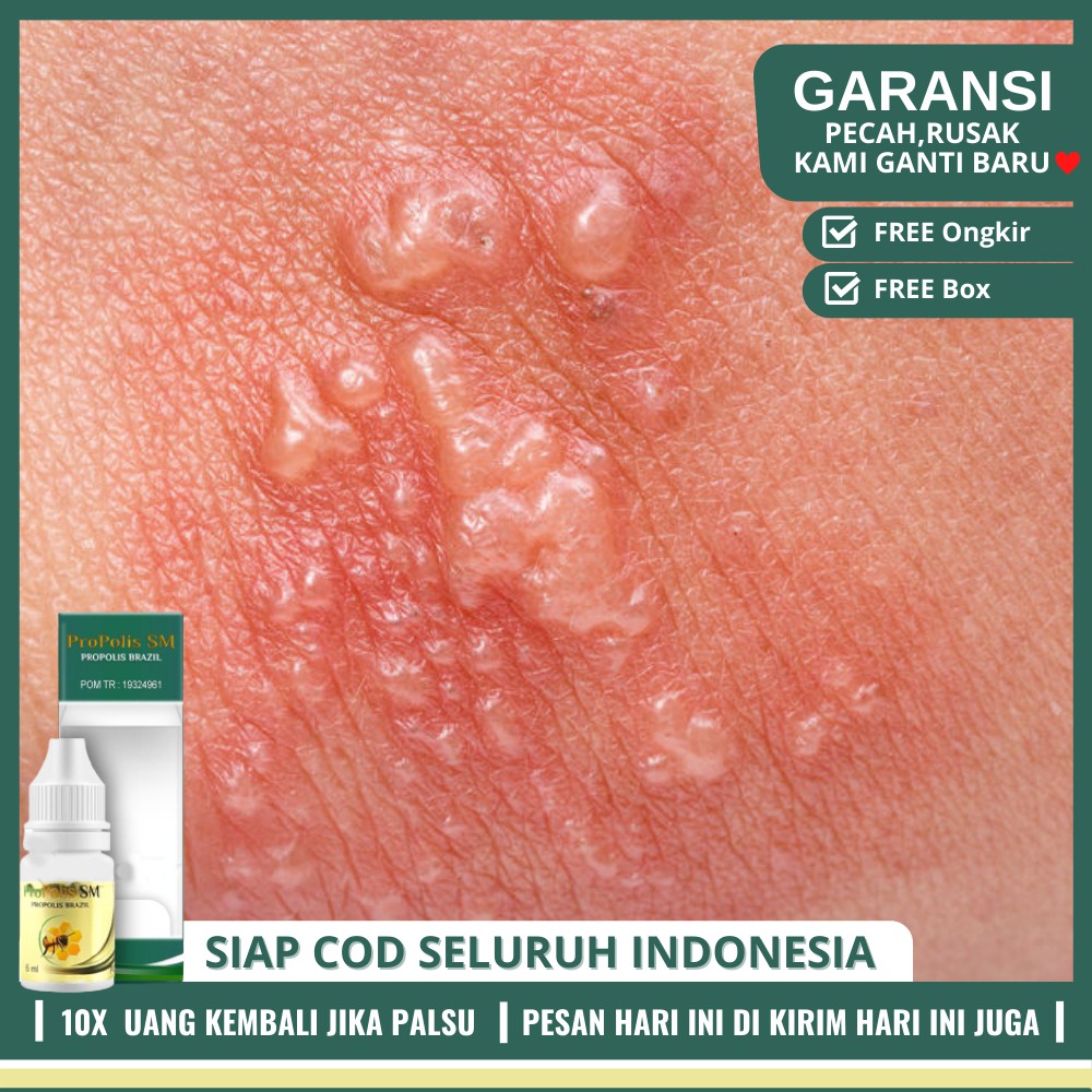 Obat Kutu Air Bernanah Dan Bengkak, Mengobati Jamur Di Telapak Kaki/Tangan, Sela Jari Kaki/Tangan