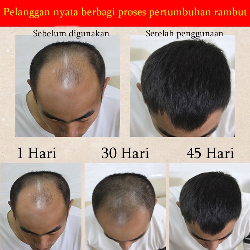 Serum penumbuh rambut  Serum Anti Rambut Rontok Hair Tonic Tonic rambut rontok Penumbuh Rambut, Alis, Jenggot, Jambang,Kumis, Alis Mengatasi rambut rontok/botak