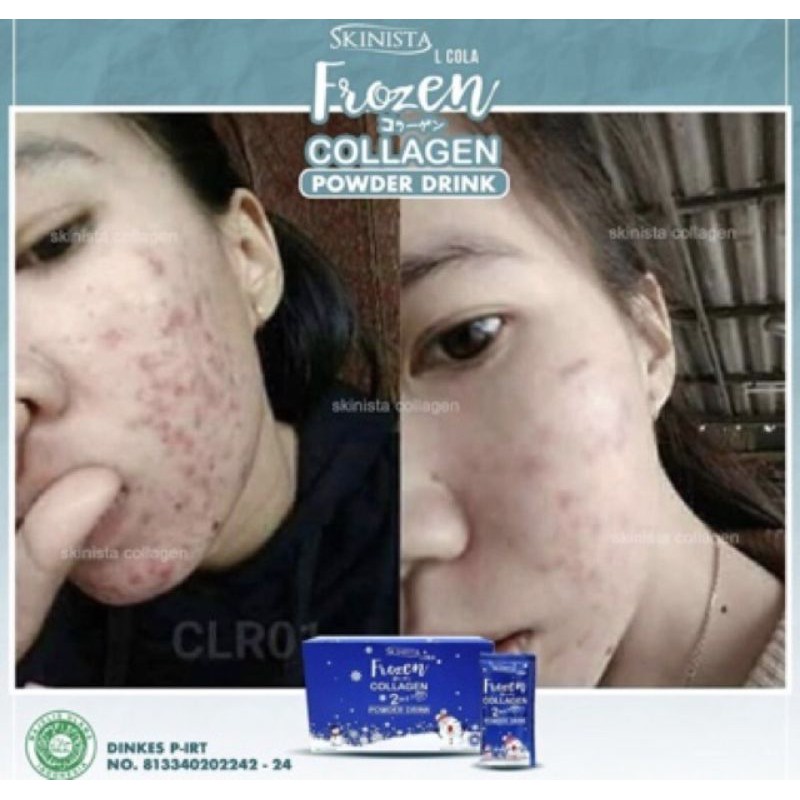 COLLAGEN BUBUK PEMUTIH TUBUH FROZEN COLLAGEN 2IN1 POWDER DRINK - COLLAGEN PENYEMBUH JERAWAT